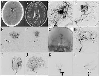 Peri-procedure efficacy and safety of one-stop hybrid surgery for the treatment of brain arteriovenous malformations: A single-center preliminary experience